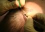 Hair Transplantation Surgery