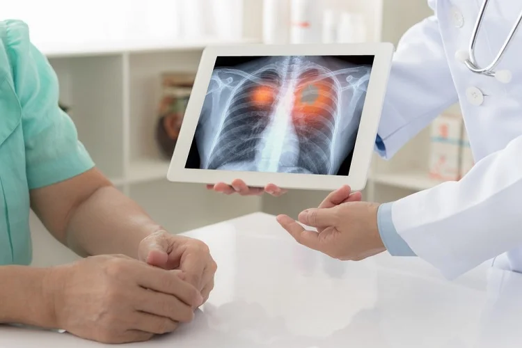 Effects of Lung Cancer and the Complications You are Likely to Have