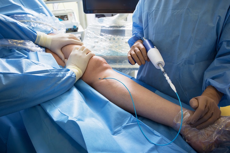 How to Expedite Recovery After Vascular Surgery